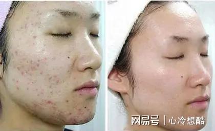 国产祛痘片测评视频在线